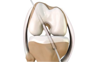 ACL Reconstruction