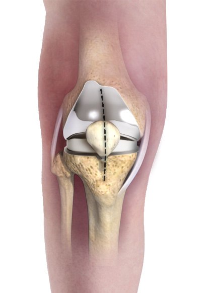 Minimally Invasive Knee Joint Replacement