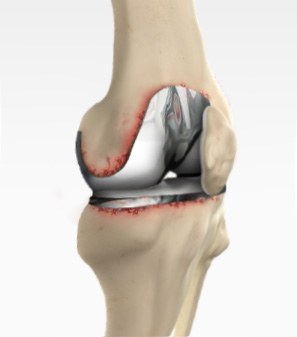 Revision Knee Replacement