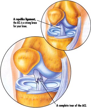 Anterior Cruciate Ligament Injury