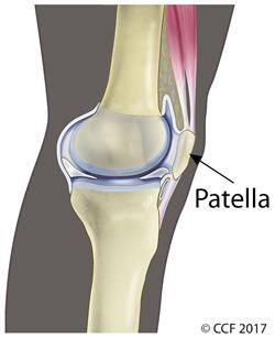 Arthroscopic Lateral Release for Patellofemoral Osteoarthritis