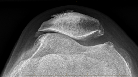 Arthroscopic Lateral Release for Patellofemoral Osteoarthritis