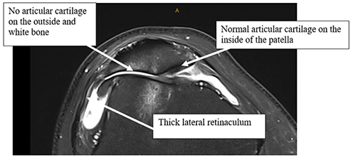 Arthroscopic Lateral Release for Patellofemoral Osteoarthritis