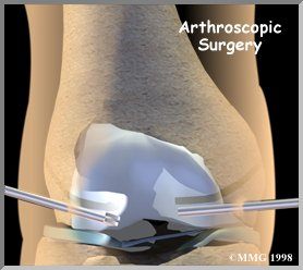 Hamstring ACL graft