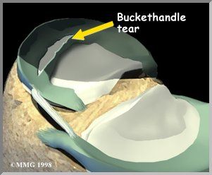 Hamstring ACL graft