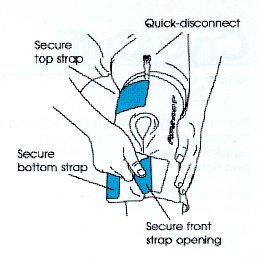 Cryocuff Information Sheet