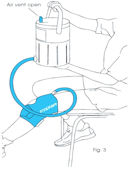 Cryocuff Information Sheet