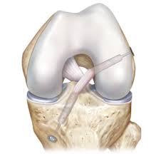 Hamstring ACL graft