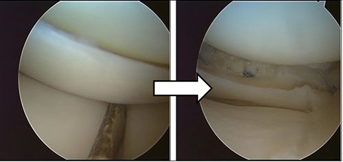  Meniscal Repair 