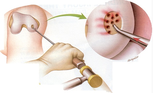 Microfracture