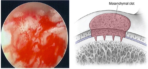 Microfracture