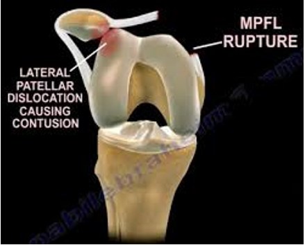 Recurrent Patellar Dislocation