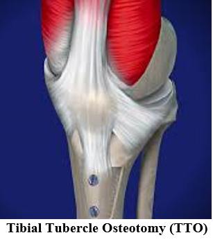 Recurrent Patellar Dislocation