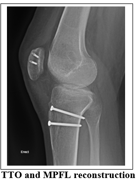 Recurrent Patellar Dislocation