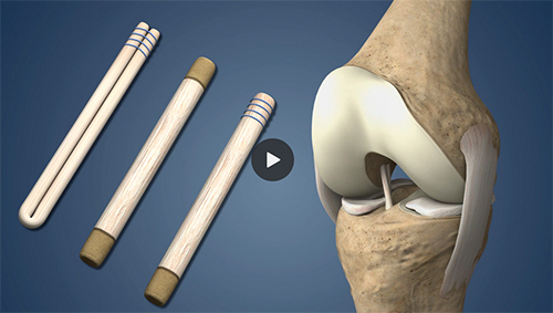 Anterior Cruciate Ligament Injury