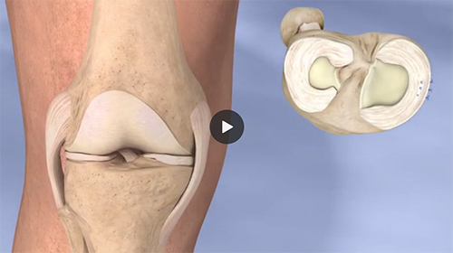 Meniscal Repair