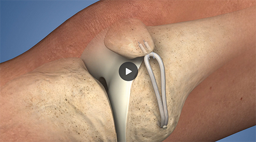 Patellar Dislocation